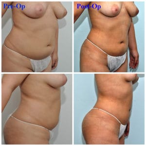 plastic surgery in miami, liposuction in miami, laser liposuction in miami, liposculpture in miami, smartlipo in miami