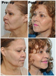 plastic surgery in miami, eyelid surgery in Miami, eye surgery in miami, dermal filler in miami, facial rejuvenation in miami, 