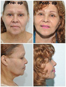 plastic surgery in miami, eyelid surgery in Miami, eye surgery in miami, dermal filler in miami, facial rejuvenation in miami, 