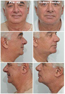 plastic surgery in miami, eyelid surgery in Miami, eye surgery in miami, dermal filler in miami, facial rejuvenation in miami, 