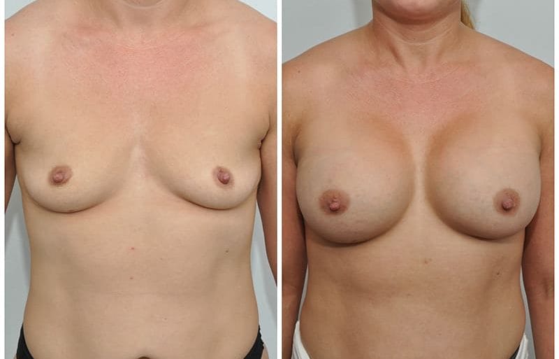 Transumbilical Breast Augmentation (TUBA)