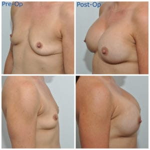 plastic surgery in miami, breast augmentation in miami, transumbilical breast augmentation in miami, breast implant in miami,