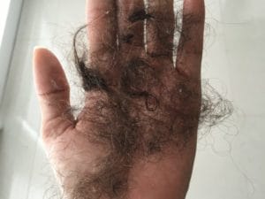 plastic surgery in miami, hair implant in miami, micro-hair transplant in miami, micro-hair restoration transplant in miami, hair restoration in miami