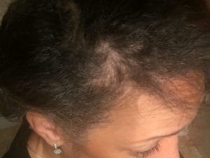 plastic surgery in miami, hair implant in miami, micro-hair transplant in miami, micro-hair restoration transplant in miami, hair restoration in miami