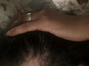 plastic surgery in miami, hair implant in miami, micro-hair transplant in miami, micro-hair restoration transplant in miami, hair restoration in miami