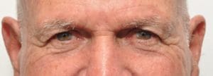 plastic surgery in miami, eyelid surgery in Miami, eye surgery in miami,
