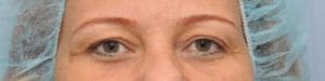 plastic surgery in miami, eyelid surgery in Miami, eye surgery in miami,