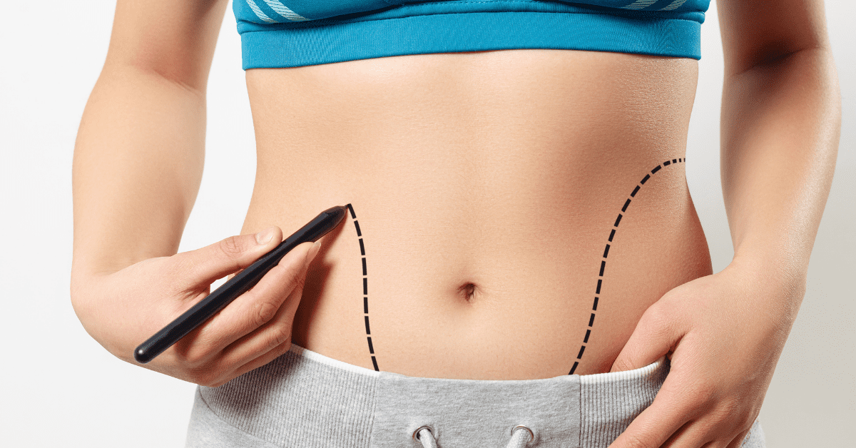 To-do List: How to Prepare for and Recover from Liposuction