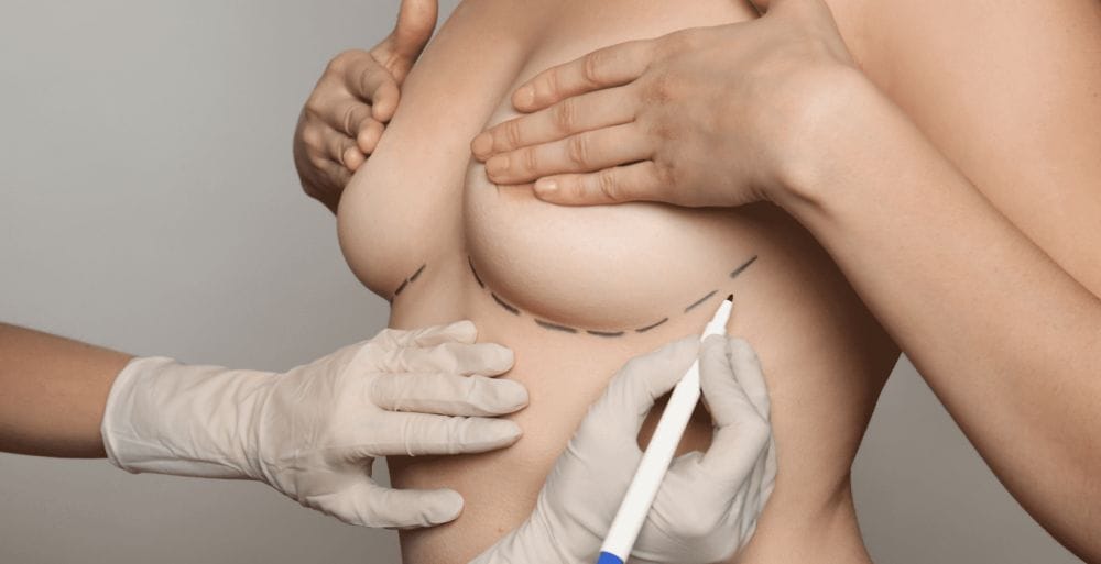 What to expect after breast augmentation in Miami