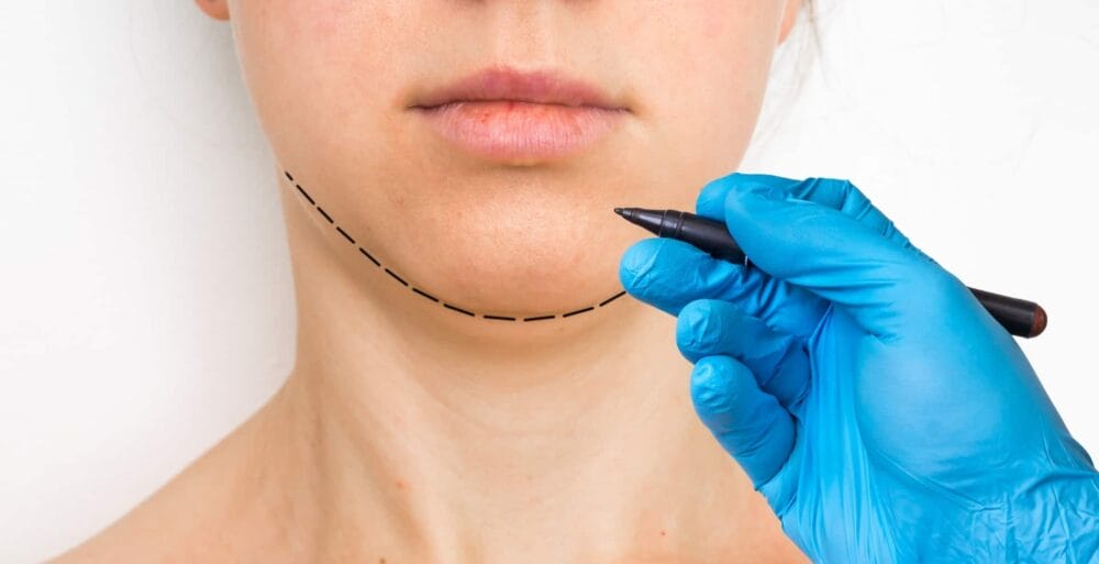 10 reasons to get chin implants or mentoplasty