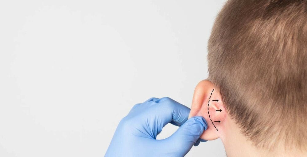 Otoplasty recovery: Do’s and don’ts after your ear surgery