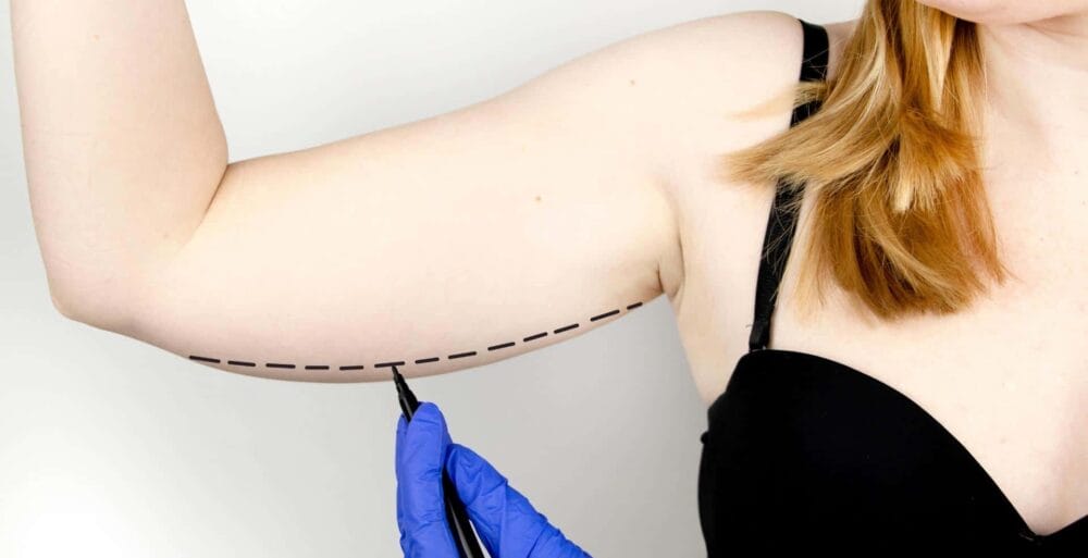 How long do arms swell after brachioplasty or arm lift surgery?