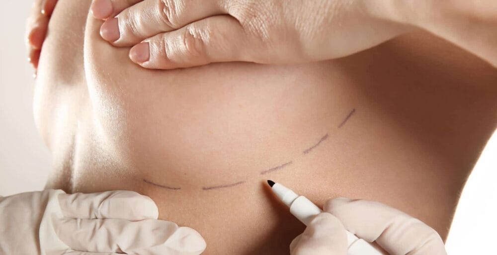 How Long Does Surgery Take For A Breast Lift
