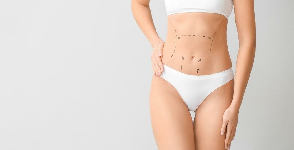 How long is the recovery from liposuction?