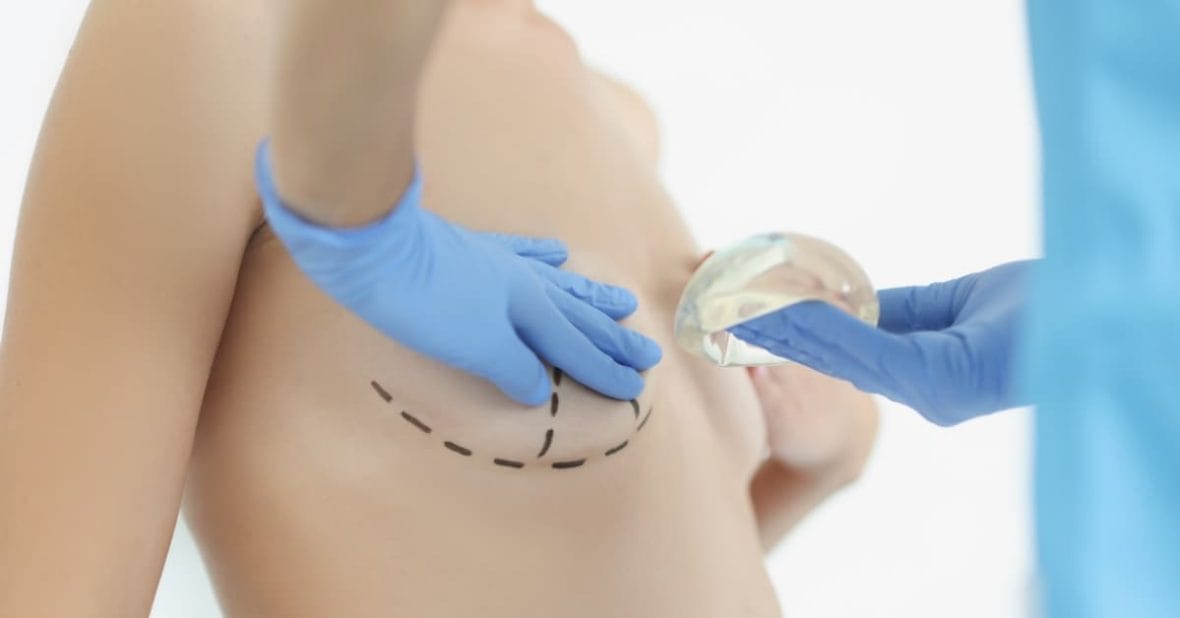 Breast Implant Placement in Miami