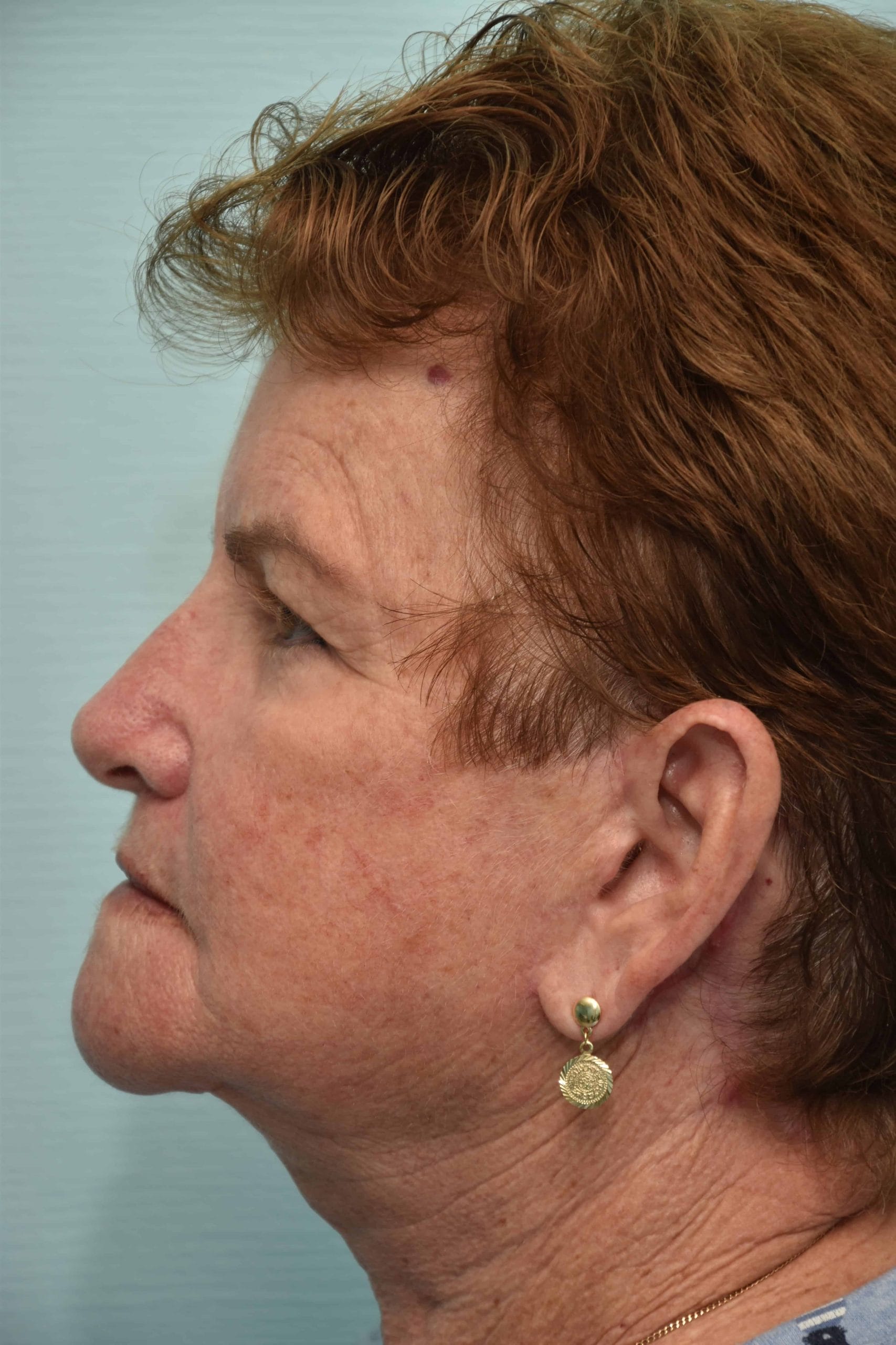 Neck-lift-surgery-10
