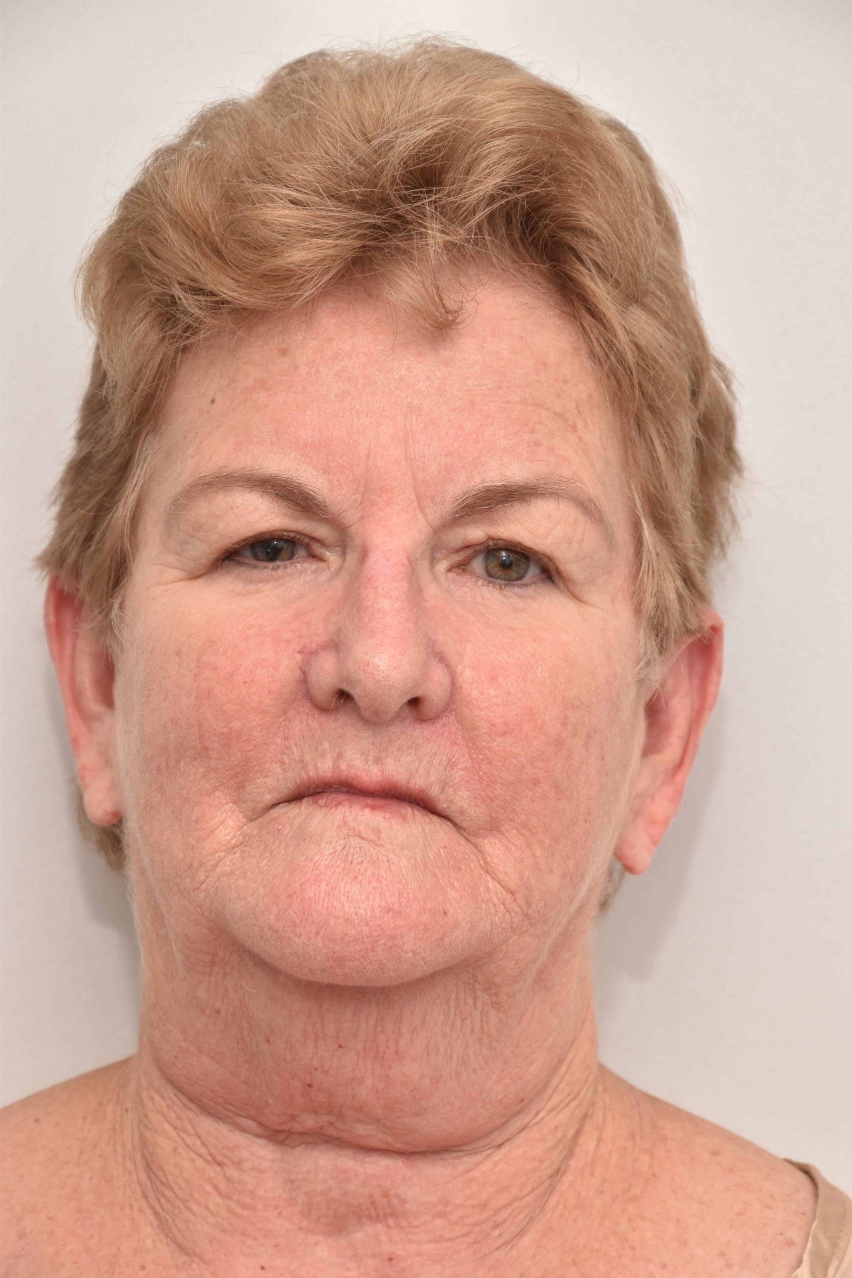 Neck-lift-surgery-11