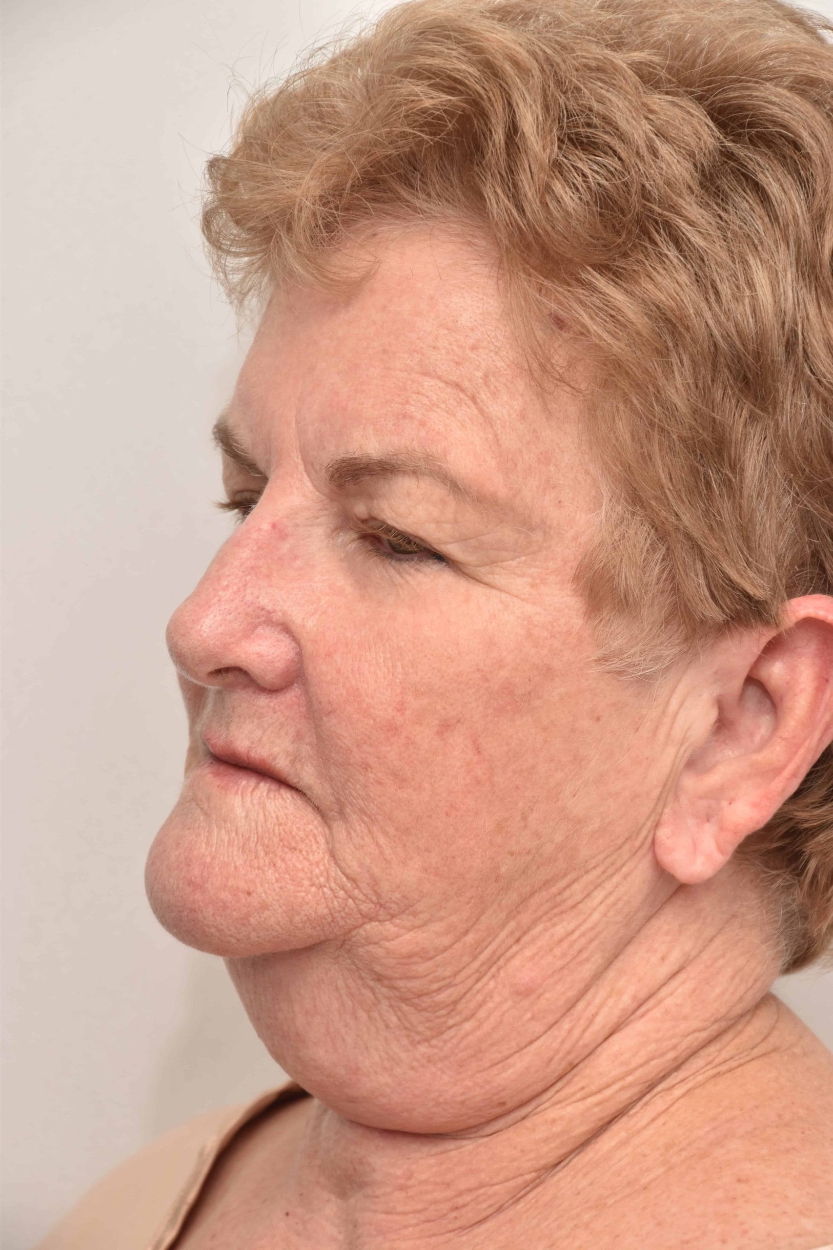 Neck-lift-surgery-6