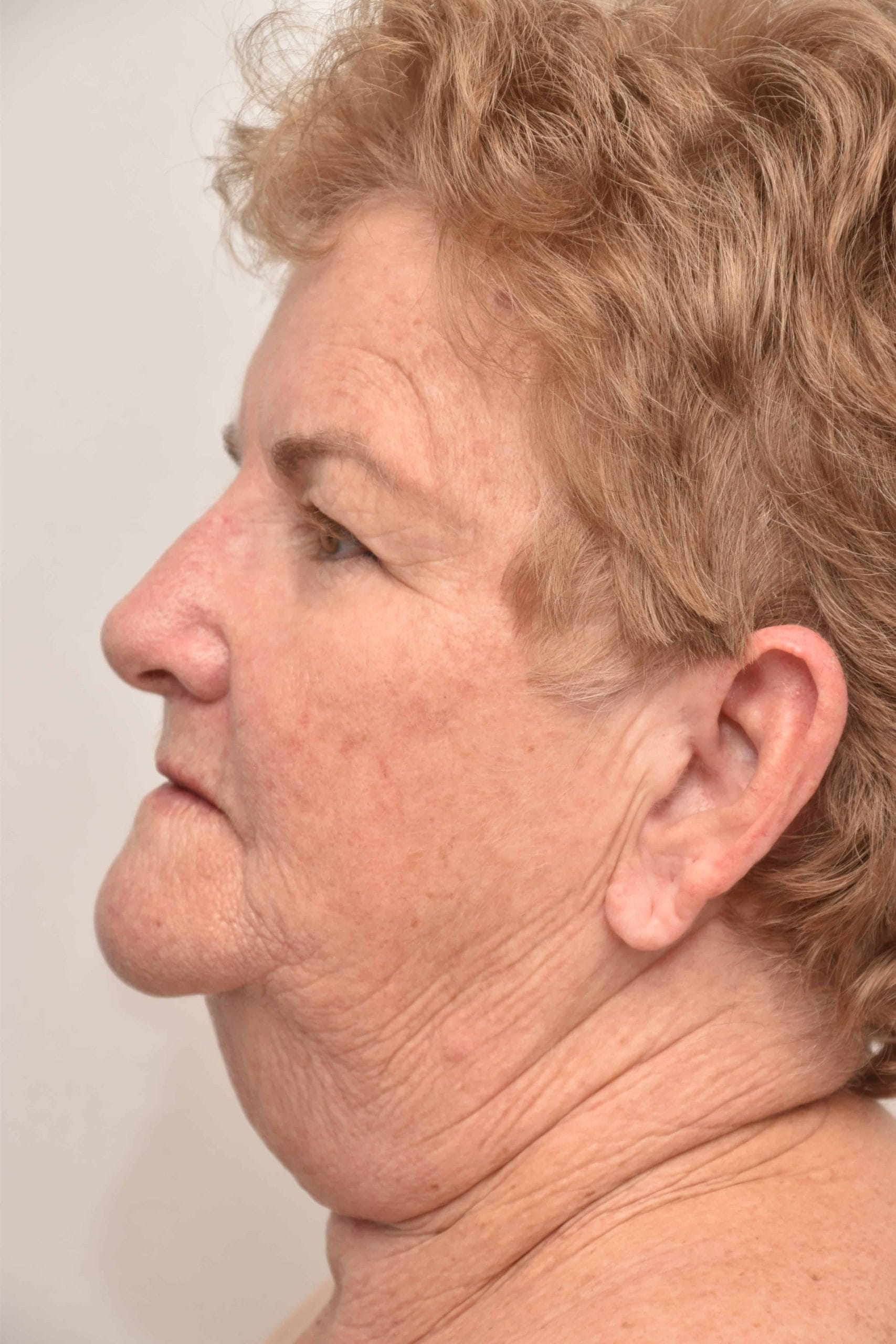 Neck-lift-surgery-7