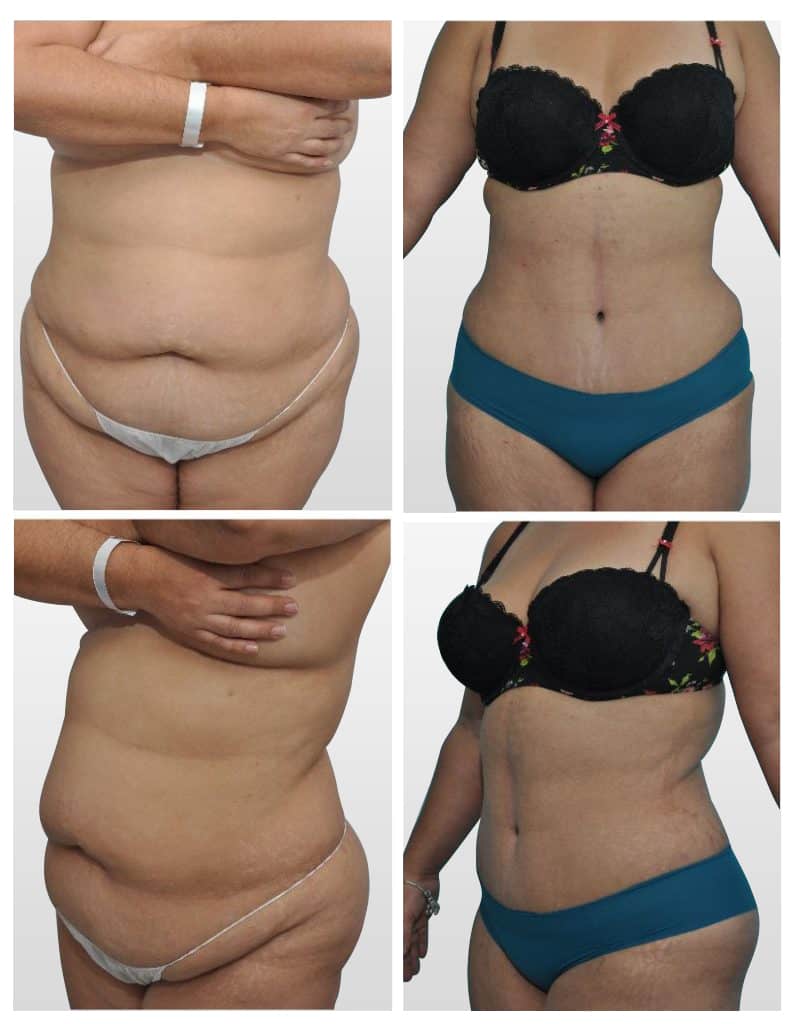 Dr. Culver talks about reverse tummy tuck. #mommymakeover #abdominopl