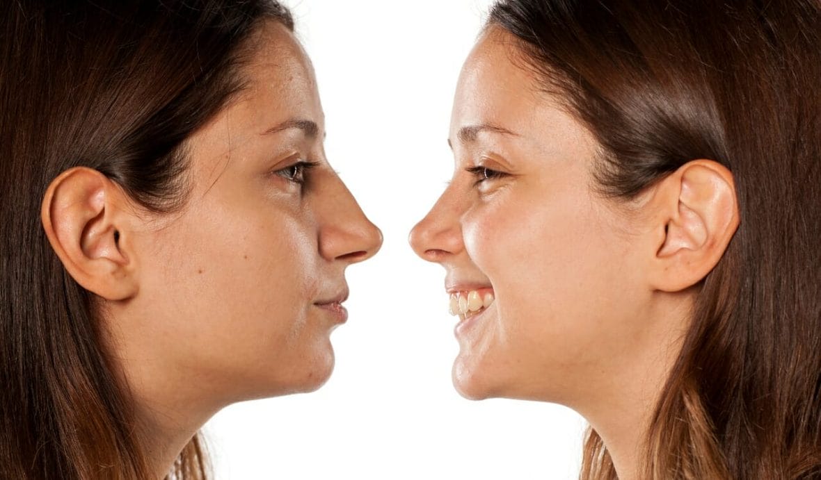 What Is Preservation Rhinoplasty?