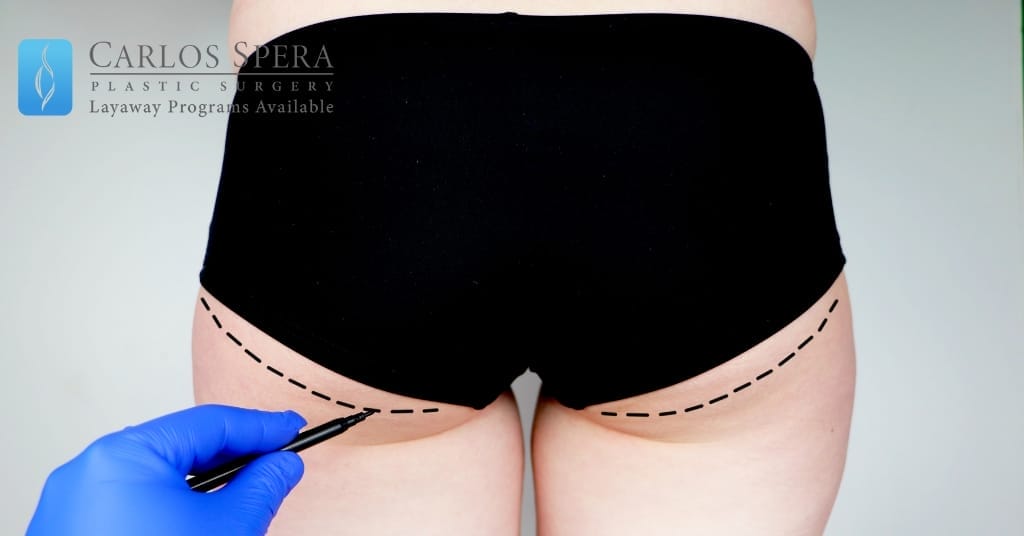 5 Things to Know Before Getting a Gluteoplasty in Miami