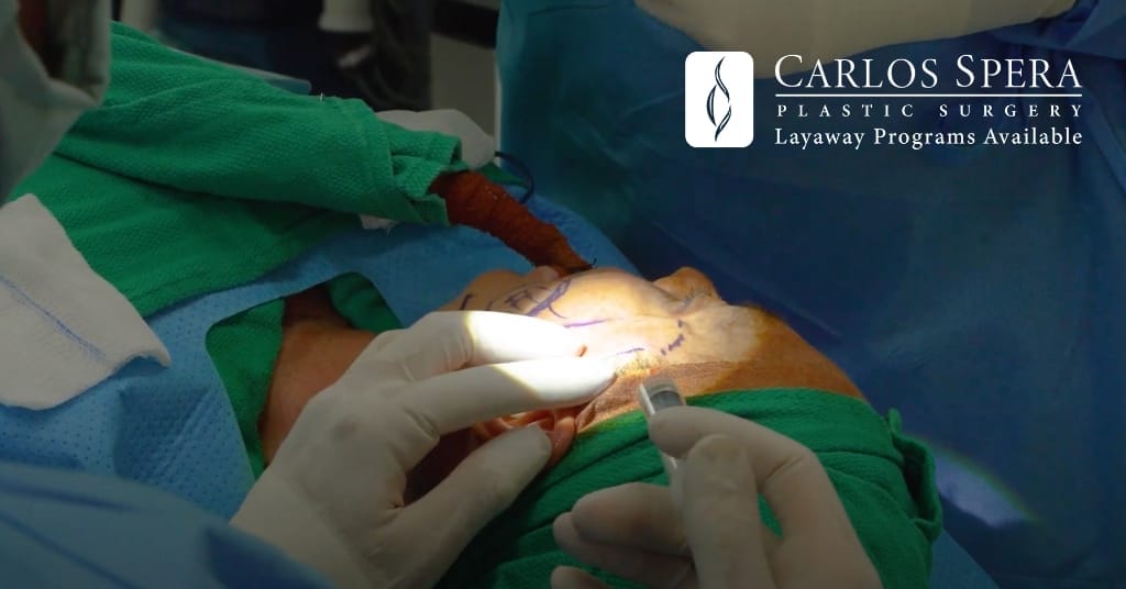 Direct Excision of Wrinkles Dr. Carlos Spera