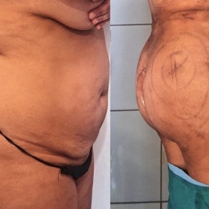 Abdominoplasty-in-Miami