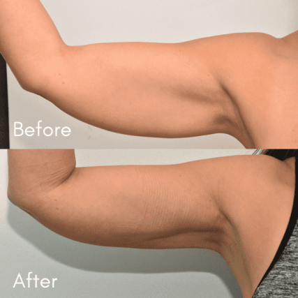 Brachioplasty-1