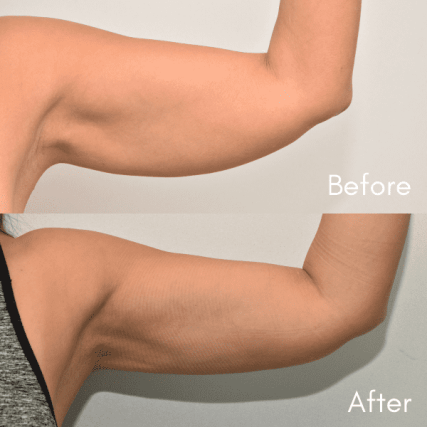 Brachioplasty-2