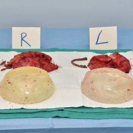 Breast-Implant-Removal-1CarlosSpera