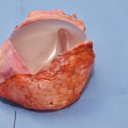 Breast-Implant-Removal-2CarlosSpera