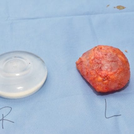 Breast-Implant-Removal-3CarlosSpera