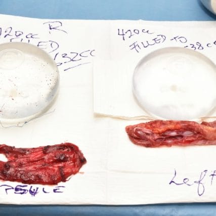 Breast-Implant-Removal-4CarlosSpera