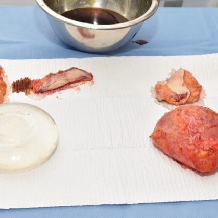 Breast-Implant-Removal-5CarlosSpera