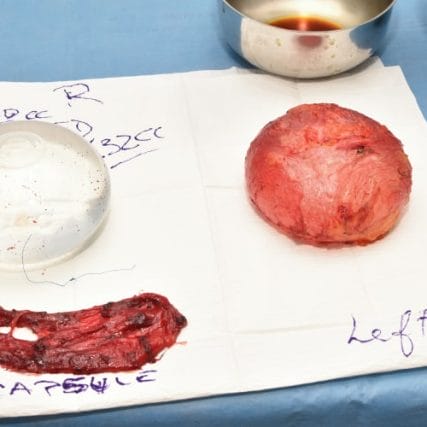 Breast-Implant-Removal-6-CarlosSpera