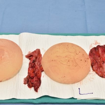 Breast-Implant-Removal-7CarlosSpera