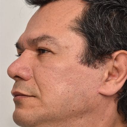 Deep-Plane-Facelift-10