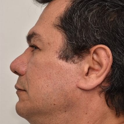 Deep-Plane-Facelift-11