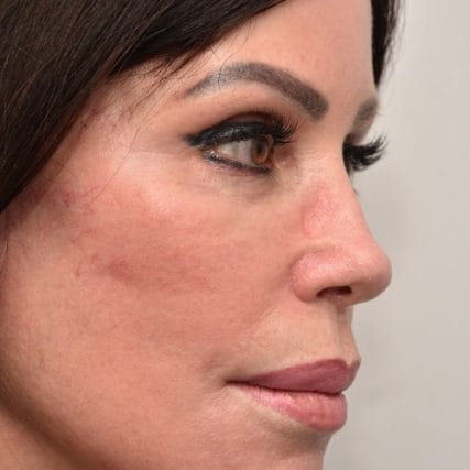 Deep-Plane-Facelift-12