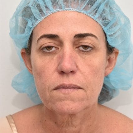 Deep-Plane-Facelift-14