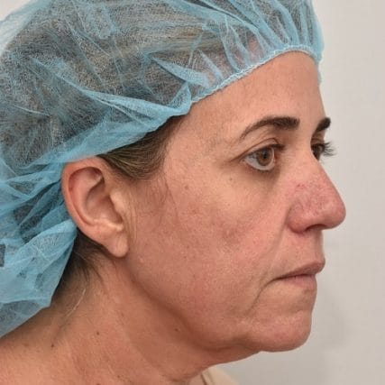 Deep-Plane-Facelift-15