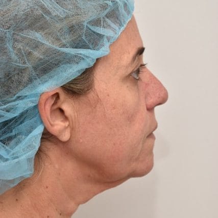 Deep-Plane-Facelift-16