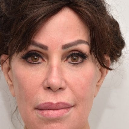 Deep-Plane-Facelift-17