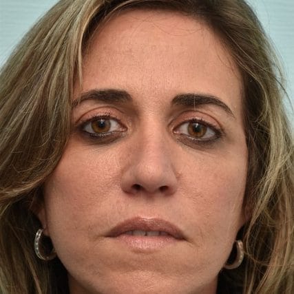 Deep-Plane-Facelift-19