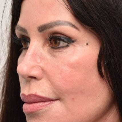 Deep-Plane-Facelift-2