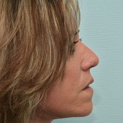 Deep-Plane-Facelift-21