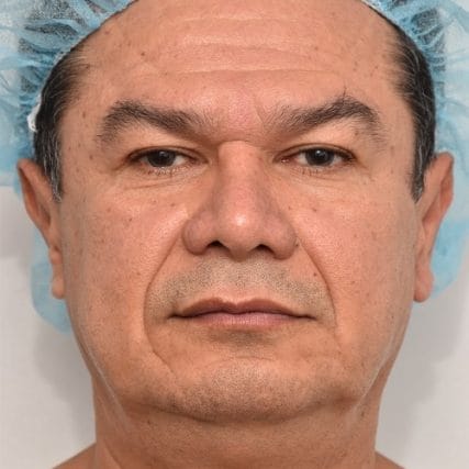 Deep-Plane-Facelift-22