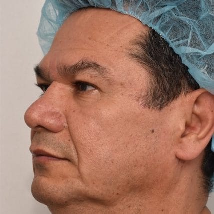 Deep-Plane-Facelift-23