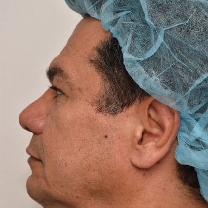 Deep-Plane-Facelift-24